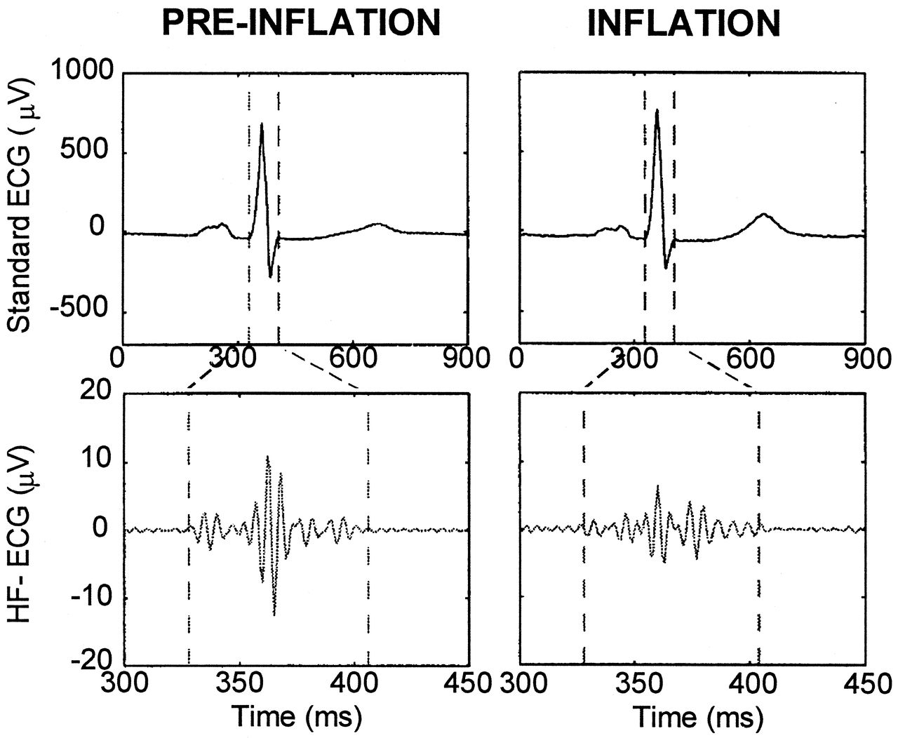 High-frequency QRS signal extracted from an ECG waveform