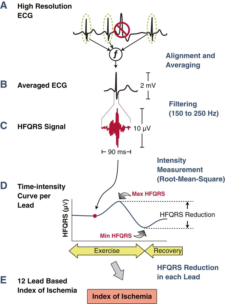 HF QRS used clinically to detect cardiac ischemia